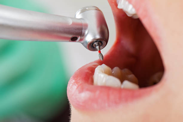 Best Lost Filling or Crown Replacement in Frankfort, KY